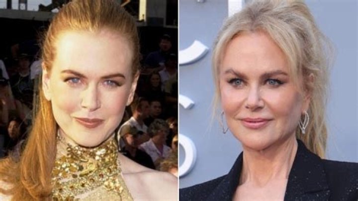 Nicole Kidman Gets a Facelift? Our Plastic Surgery Experts Weigh In